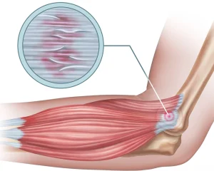 Tenisçi Dirseği İçin Egzersiz ve Rehabilitasyon