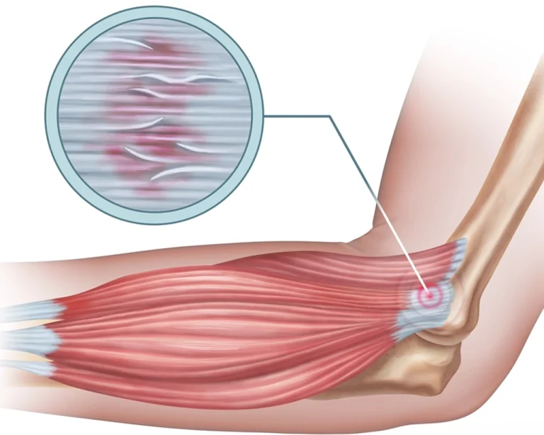 Tenisçi Dirseği İçin Egzersiz ve Rehabilitasyon